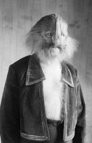 Eşine az rastlanan hastalıklar