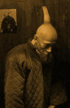 Eşine az rastlanan hastalıklar