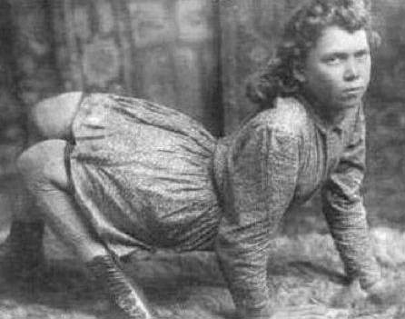 Eşine az rastlanan hastalıklar