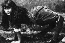 Eşine az rastlanan hastalıklar