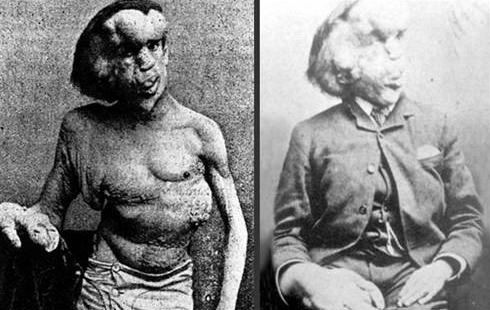 Eşine az rastlanan hastalıklar