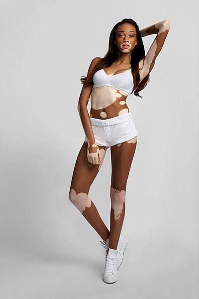 Hastalığını güzelliğe çevirdi