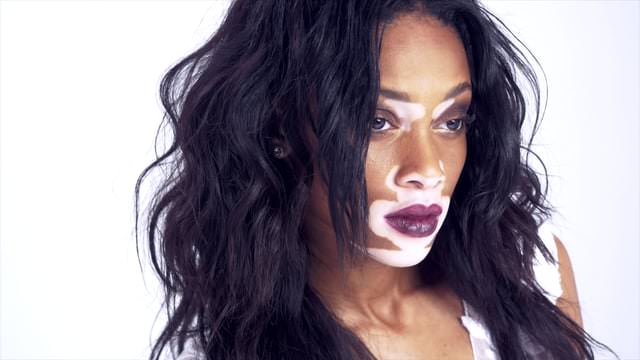 Hastalığını güzelliğe çevirdi