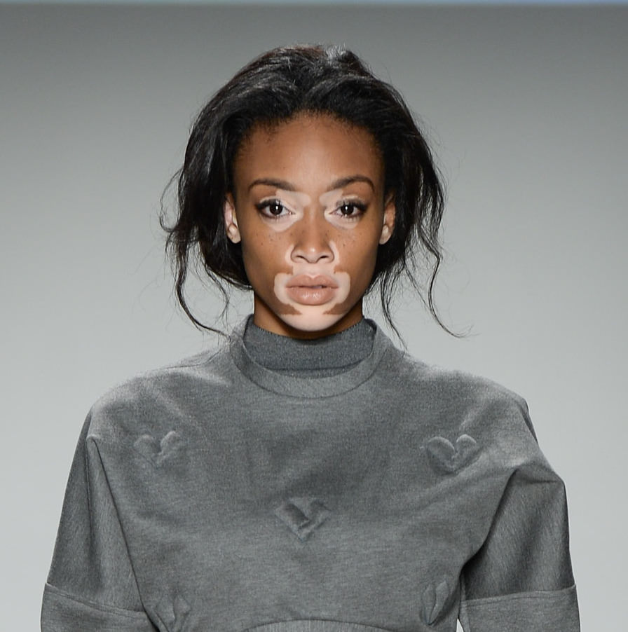 Hastalığını güzelliğe çevirdi