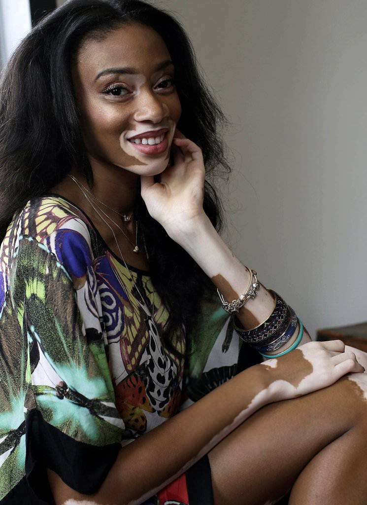 Hastalığını güzelliğe çevirdi