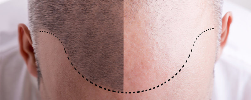 Başarılı saç ekimi için 3 adım önerisi