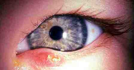 Bahar ayları bu göz hastalığını alevlendiriyor!