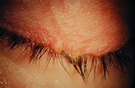 Bahar ayları bu göz hastalığını alevlendiriyor!