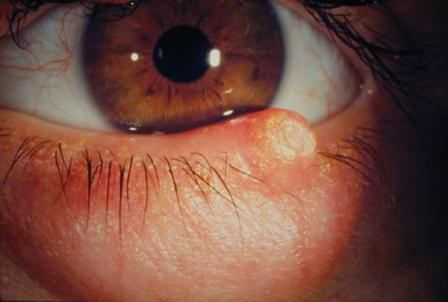 Bahar ayları bu göz hastalığını alevlendiriyor!