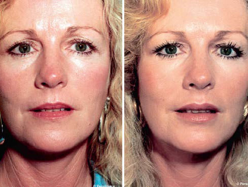 Dudaklarınıza sihirli dokunuş: Eros yayı estetiği