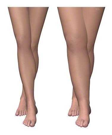 Estetikte son trend bilek İnceltme