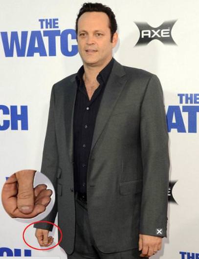 Ünlülerin fiziksel kusurları