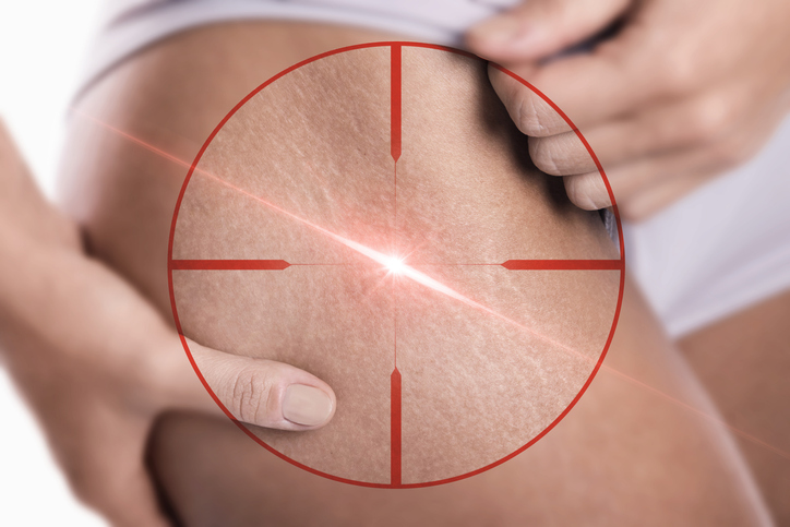 Lazer epilasyon öncesi bunlara dikkat edin!