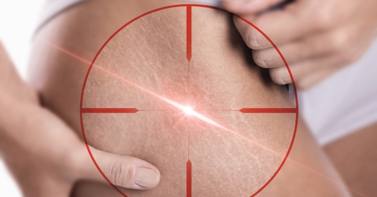 Lazer epilasyon öncesi bunlara dikkat edin!